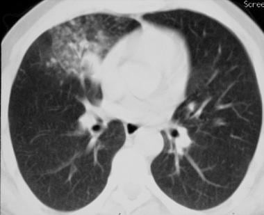 CT scan obtained with pulmonary window setting in 