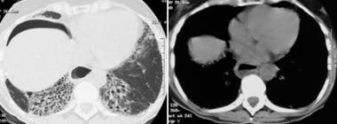High-resolution CT demonstrates extensive basal ho