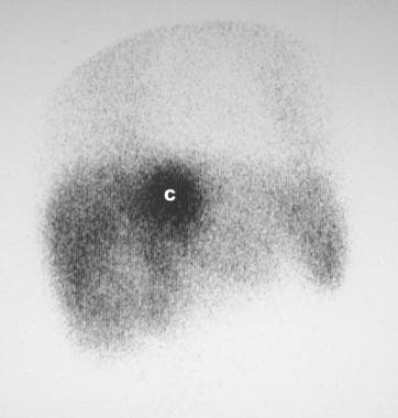 Technetium-99m sulfur colloid scan in a 53-year-ol