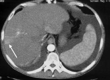 Nontumorous arterioportal shunts occur spontaneous