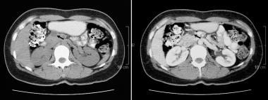 Nonenhanced (left) and contrast-enhanced axial CT 