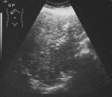 Sagittal sonogram through the liver shows a hetero
