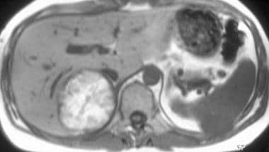 A metastatic melanoma to the right adrenal gland a