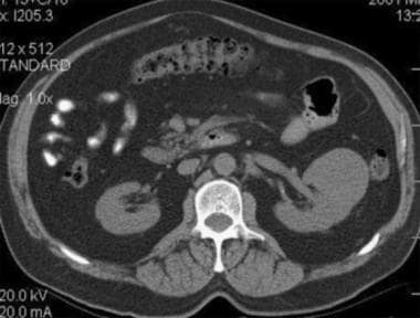 Case 5. Typical renal cell carcinoma. CT scan obta
