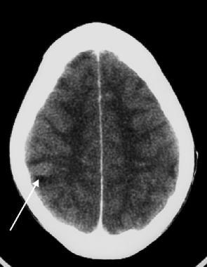 Contrast-enhanced head CT scan reveals a low-atten
