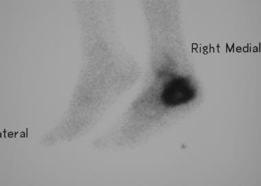 Osteosarcoma. Lateral isotope bone scan reveals in