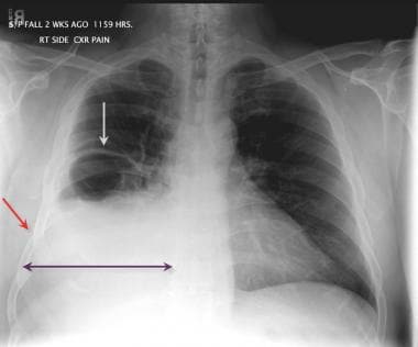 Rib Fracture Imaging: Overview, Radiography, Computed Tomography