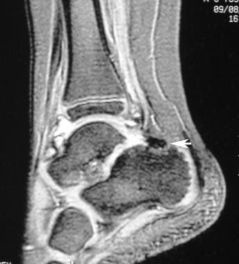 Sagittal magnetic resonance image of the ankle joi