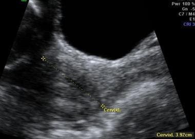 Transabdominal sonogram showing a normal cervix. 
