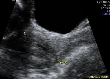 Cervical Incompetence Imaging Practice Essentials Magnetic