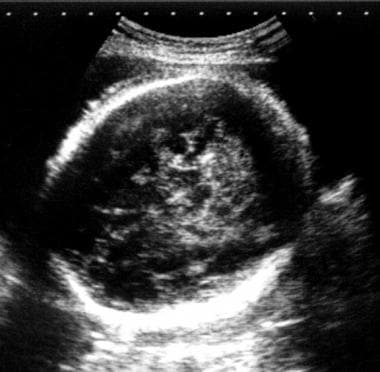 Transverse sonogram of a normal fetal head. The ha