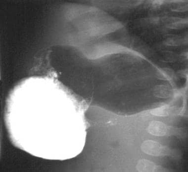 Lateral view from an upper gastrointestinal study 