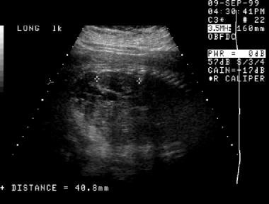 第二次产前超声检查(同一病人