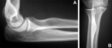 Normal radial tuberosity. (A) On the lateral view,
