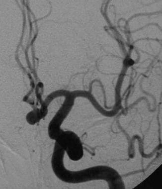 Anterior communicating artery aneurysm. An increas