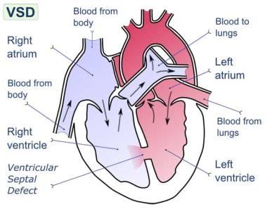 梗死后室间隔破裂。Ventric