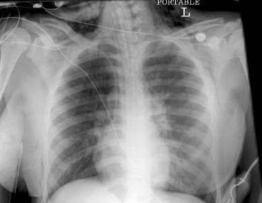 Chest radiograph demonstrates pneumomediastinum, w