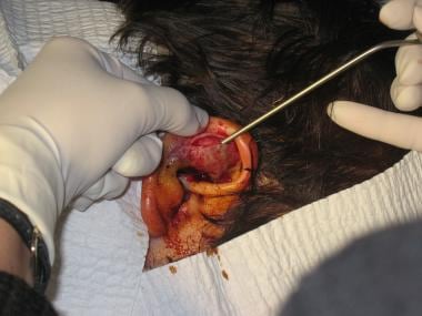 Auricular hematoma incision and drainage. 