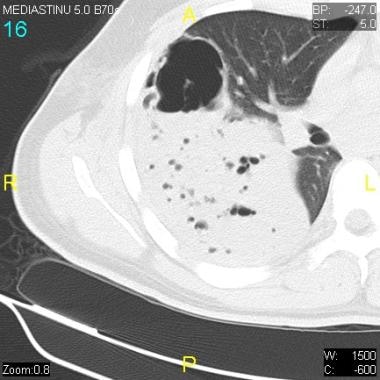 CT scan reveals a lung abscess with an air-fluid l