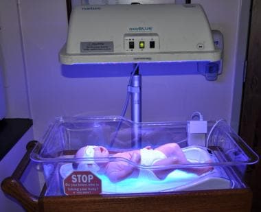 phototherapy for jaundice
