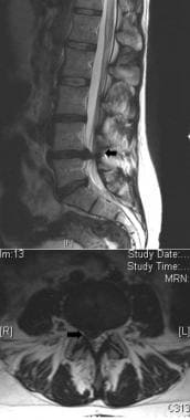 discectomy before and after