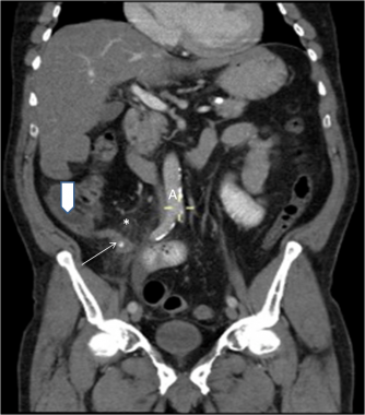 CT of the abdomen and pelvis using oral and IV con