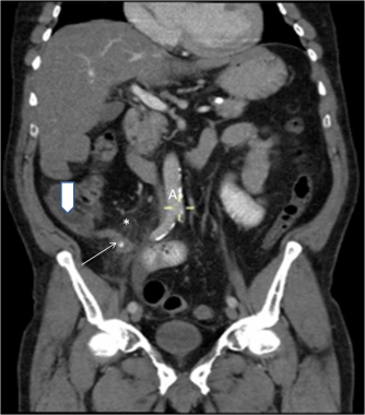 why ct scan abdomen pelvis