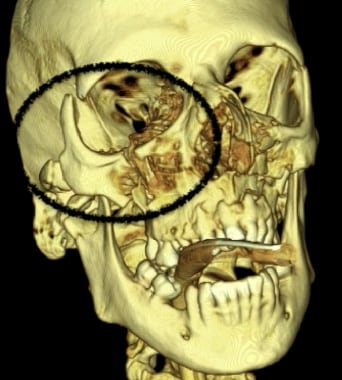 3D CT scan of right displaced zygomaticomaxillary 