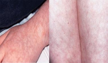 Livedo reticularis of the upper and lower extremit