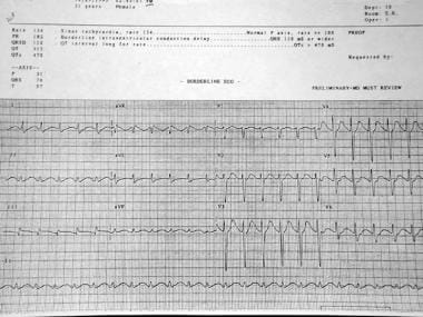Toxicity, antidepressant. ECG shows the terminal R