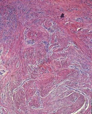 Dermal tumor with interlacing spindle-shaped cells