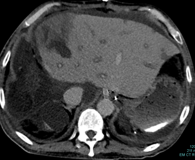 C-1: Gortex hepatic artery graft thrombosis in a 5