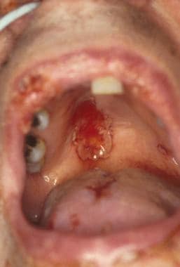 Herpes simplex virus ulceration on the hard and so