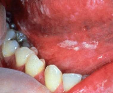 candida oral thrush