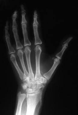 Radiologic findings of a hand in a patient with ca