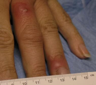 Paronychial erythema and edema with associated pus