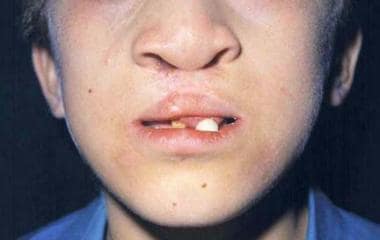 Typical cleft lip/palate and maxillary hyperplasia