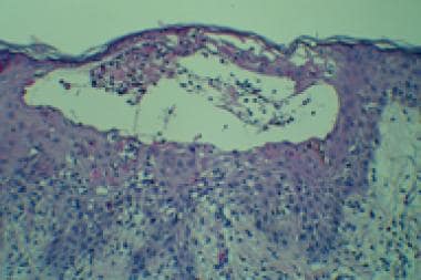Histologic features of a vesicle in a 20-day-old f