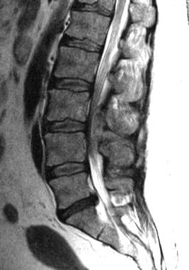 Spinal epidural abscess lumbar area. 