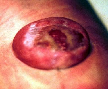 Myelomeningocele in a newborn. 