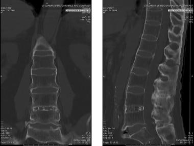 CT scan of the L-spine in a patient with AS showin