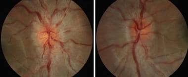 mog associated optic neuritis