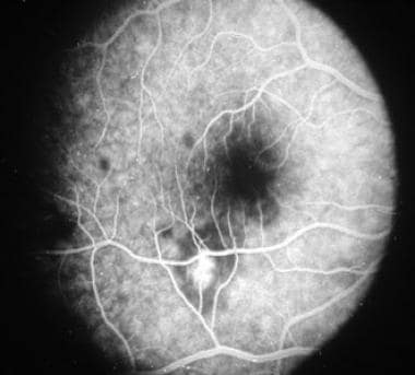 Fluorescein angiography showing peripheral hypoflu