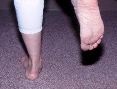 Pes planus (flatfoot). Single-limb heel-rise test.