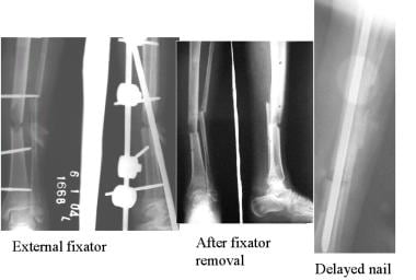 Circular external fixator application for midshaft tibial