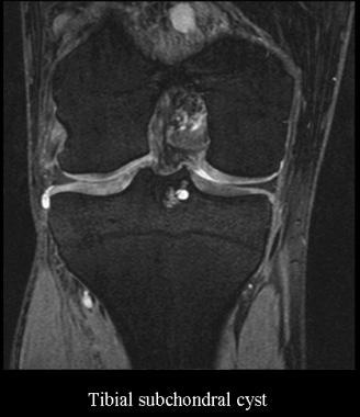 胫骨软骨下囊肿。James K. DeOr提供