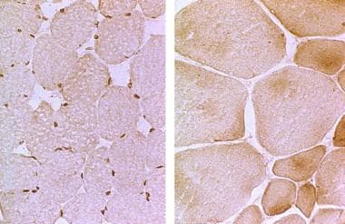 Left: The photomicrograph is a muscle biopsy with 