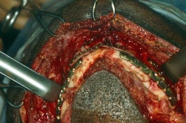 Mandibular fracture. Intraoperative view demonstra