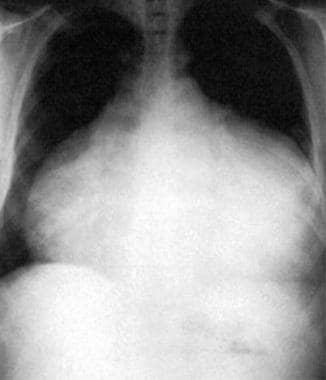 This anteroposterior-view chest radiograph shows a
