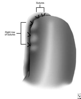 Completado fundoplicatura de Dor. 